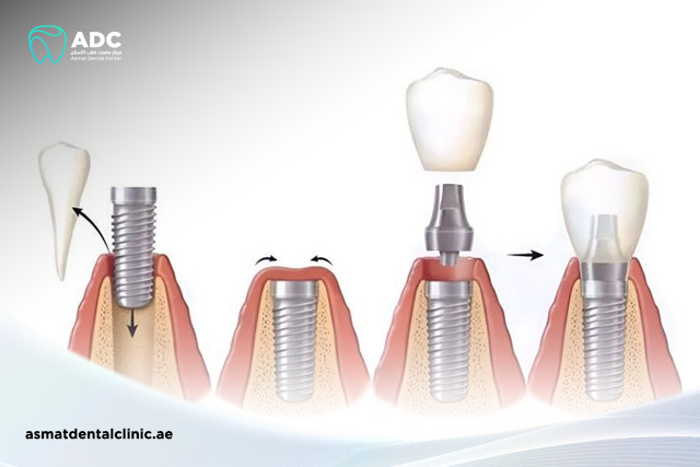 مراحل-زراعة-الاسنان